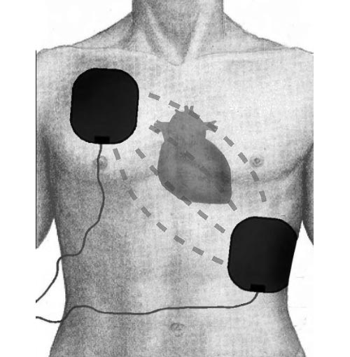 Defibrillatore semiautomatici disposizione piastre paziente ...
